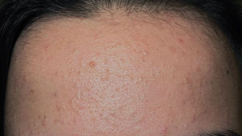 Les meilleures stratégies pour combattre l’acné