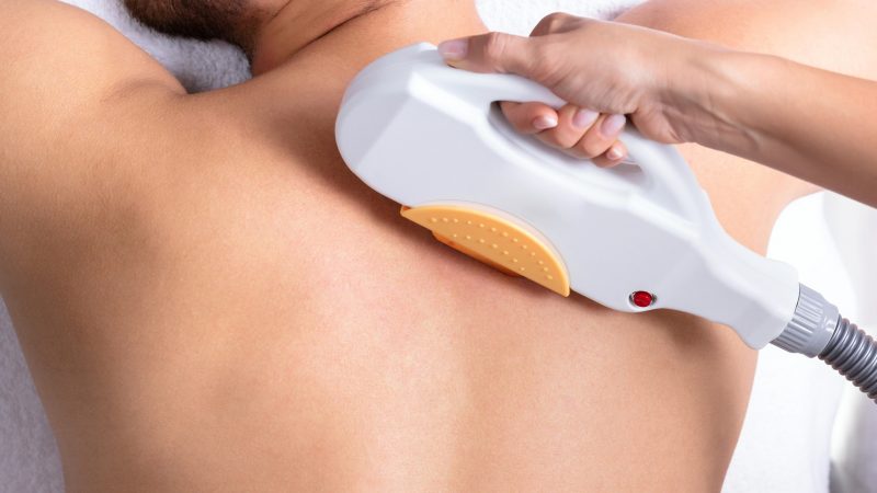 Épilation laser du dos : quels avantages ? 