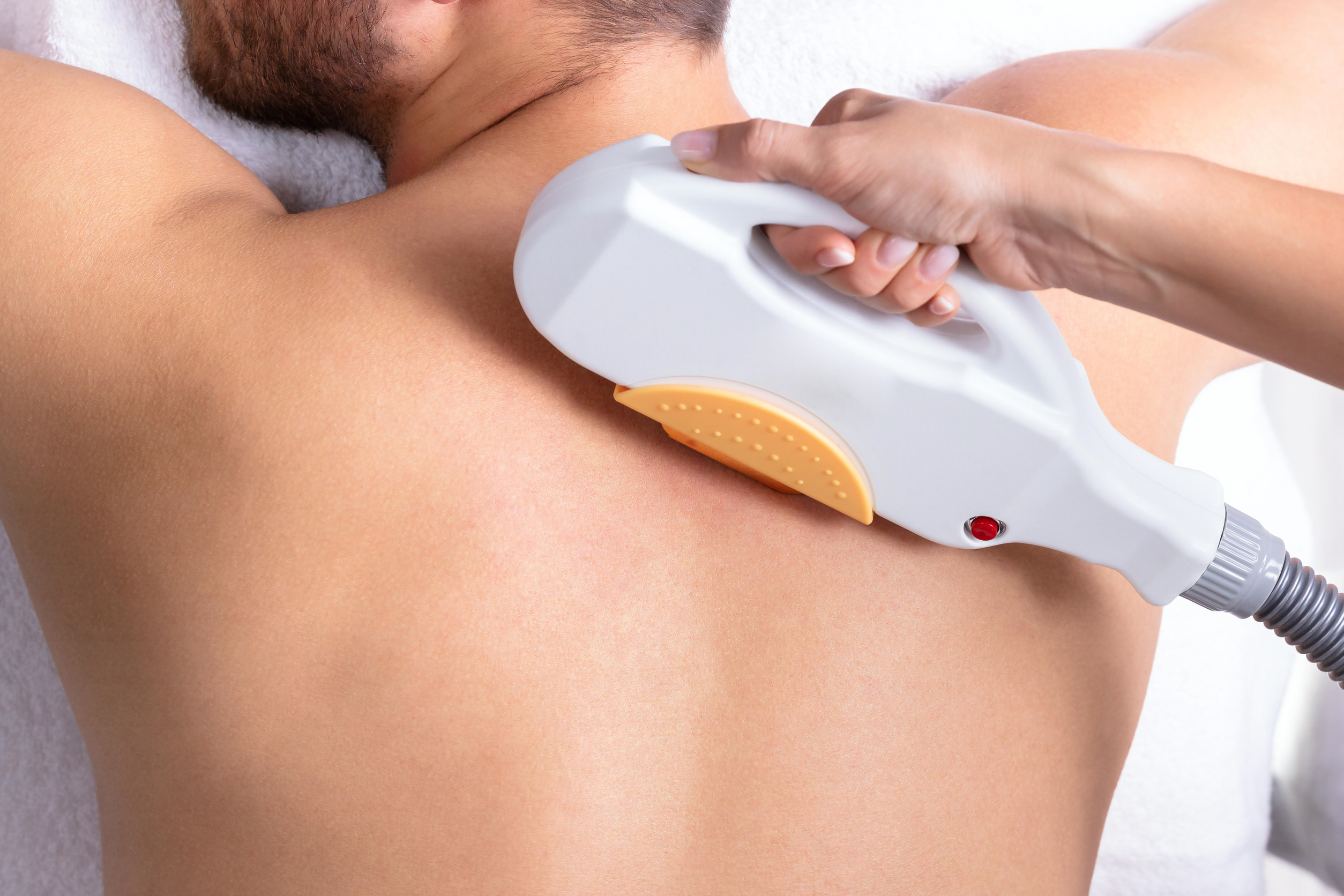 Épilation laser du dos : quels avantages ? 